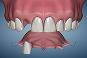 Flipper Denture Upper Lateral Incisor